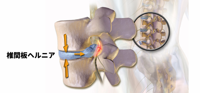 椎間板ヘルニア発症のメカニズム｜豊中市の整体院が腰痛の仕組みを解説