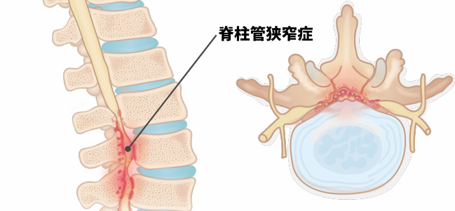 脊柱管狭窄症発症のメカニズム｜腰痛の原因を理学療法士が解説